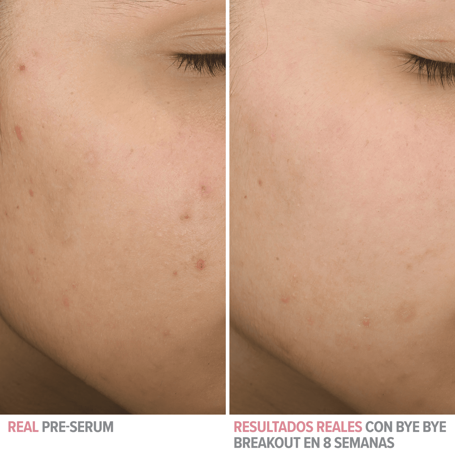 IT Cosmetics Bye Bye Breakout Salicylic Acid Acne Serum - Imagen 3