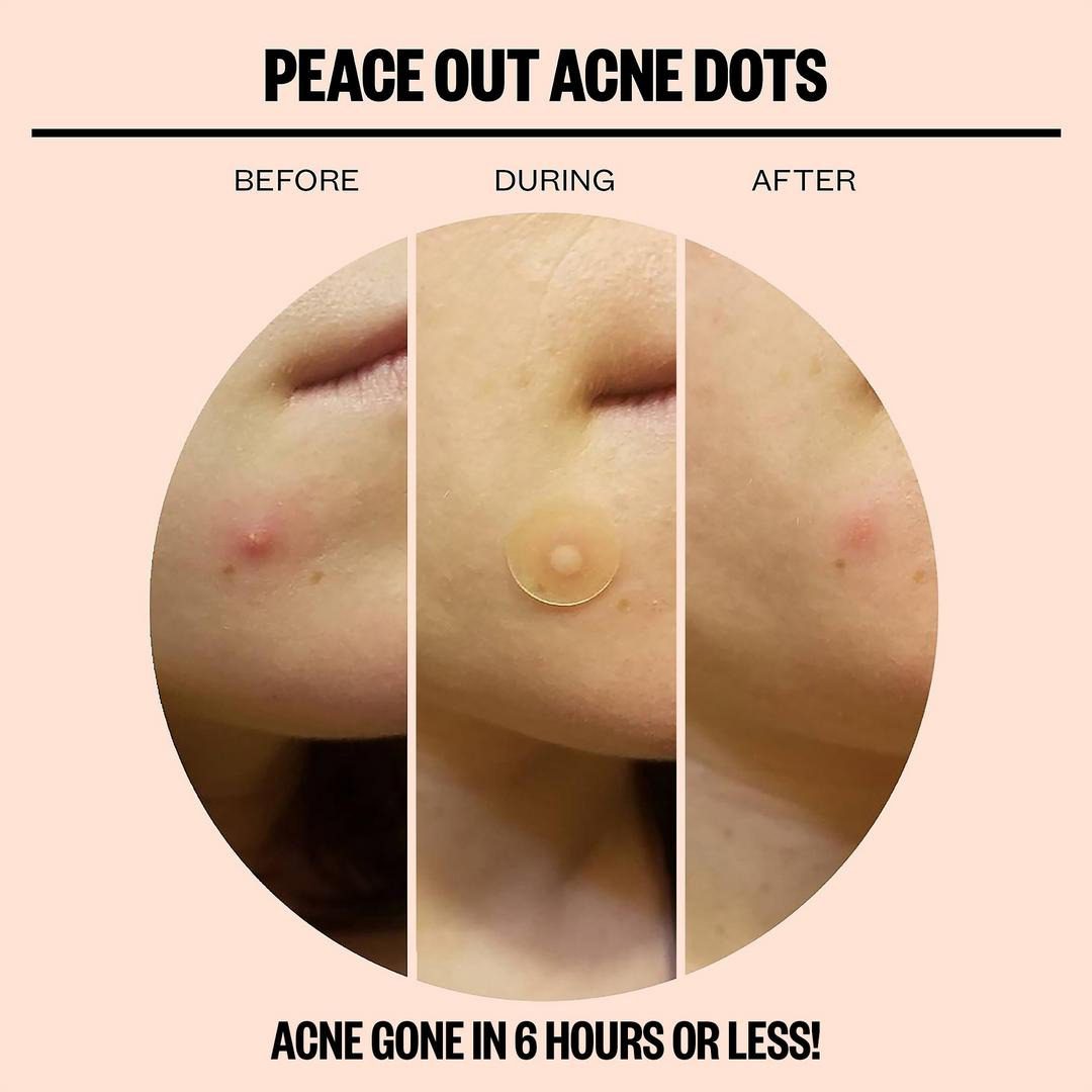 Peace Out Salicylic Acid Acne Healing Dots - Imagen 4