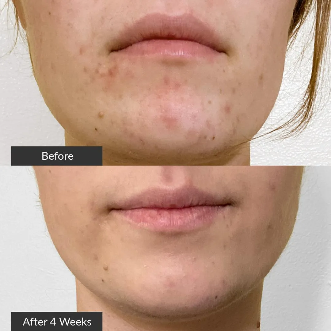 PMD Clean Acne - Blue Light Therapy Spot Treatment - Imagen 2
