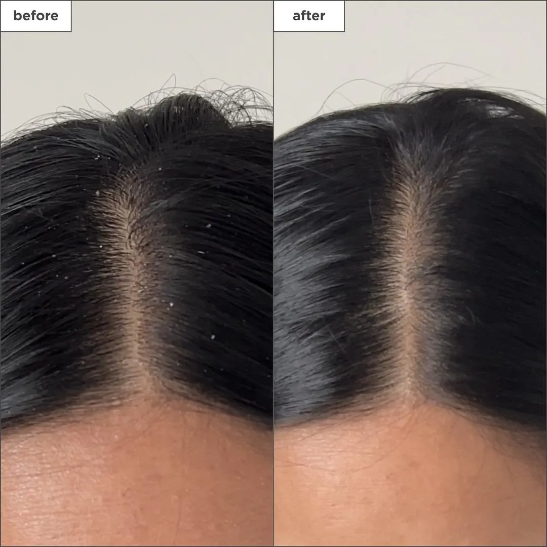 Briogeo Scalp Revival Charcoal + Tea Tree Buildup Detox Spray - Imagen 3