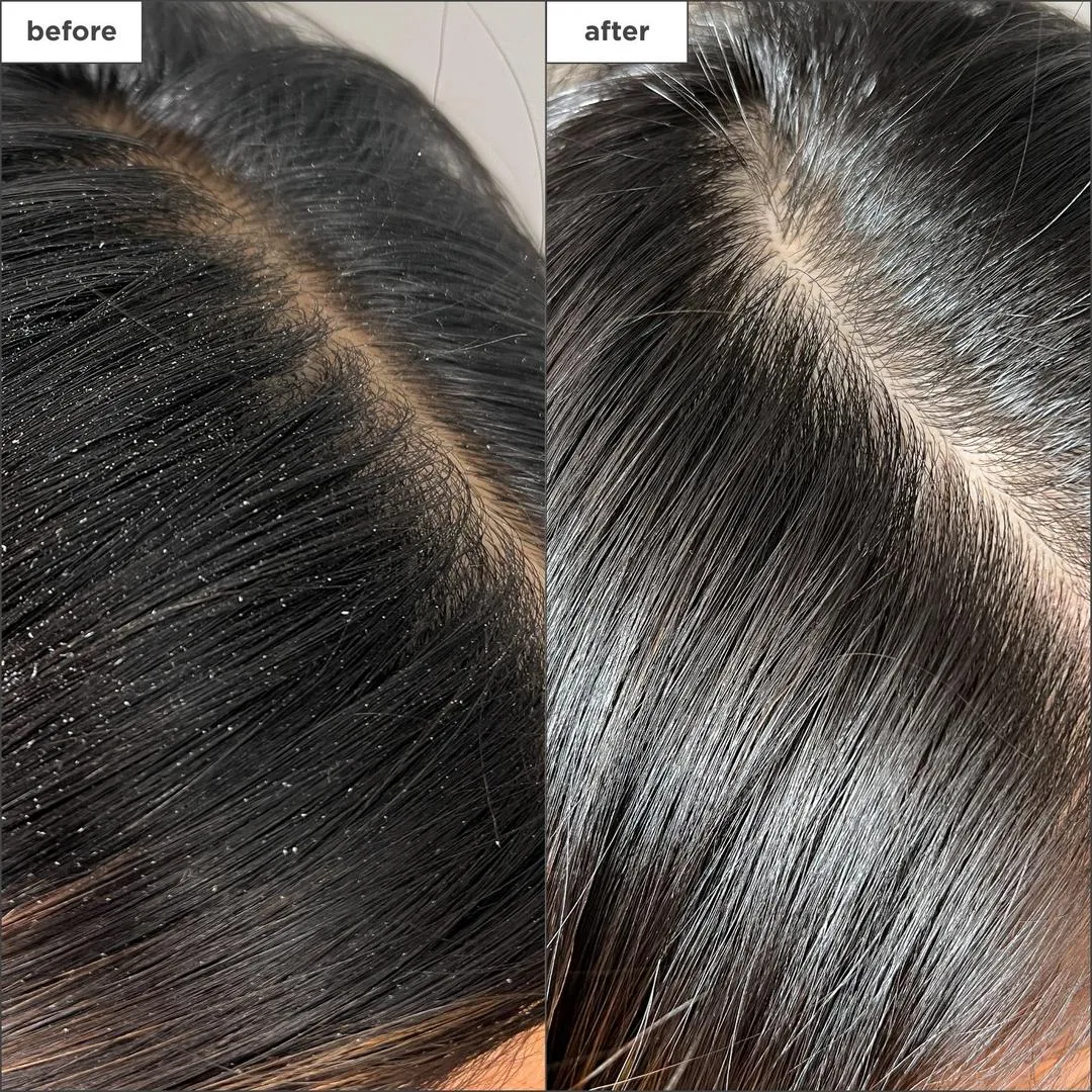 Briogeo Scalp Revival Charcoal + Tea Tree Buildup Detox Spray - Imagen 2